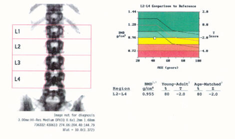 Focus On Your Bone Density Image